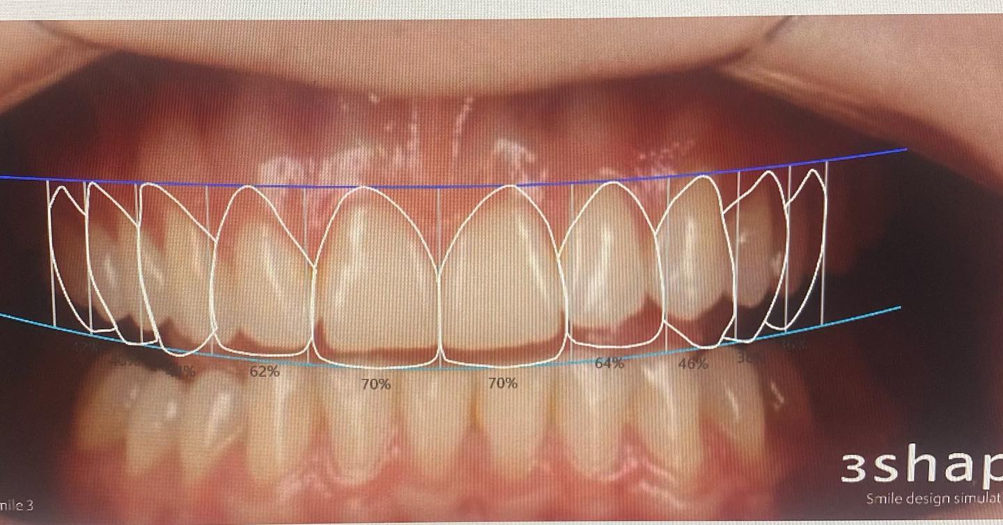 Smile Design